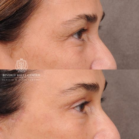 Beverly Hills Center Female Patient Before and After AuraLyft, Brow Lift Procedure