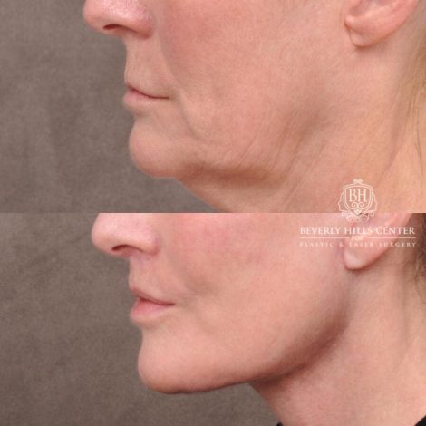 Beverly Hills Center Female Patient Before and After AuraLyft with TCA Peel and Lip Lift