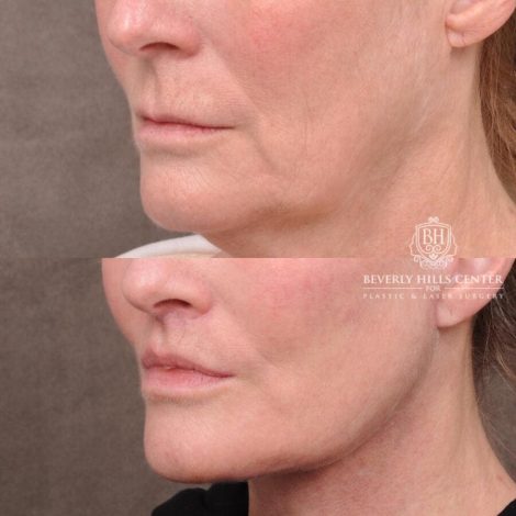 Beverly Hills Center Female Patient Before and After AuraLyft with TCA Peel and Lip Lift