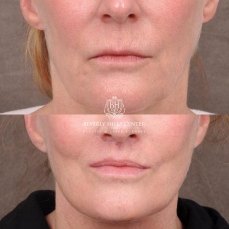 Beverly Hills Center Female Patient Before and After AuraLyft with TCA Peel and Lip Lift