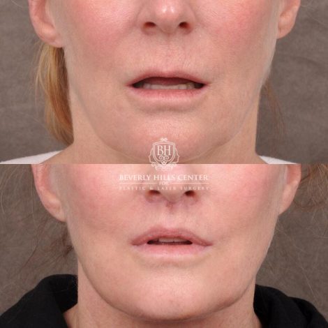 Beverly Hills Center Female Patient Before and After AuraLyft with TCA Peel and Lip Lift