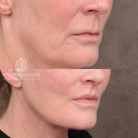 Beverly Hills Center Female Patient Before and After AuraLyft with TCA Peel and Lip Lift
