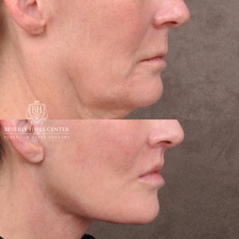 Beverly Hills Center Female Patient Before and After AuraLyft with TCA Peel and Lip Lift