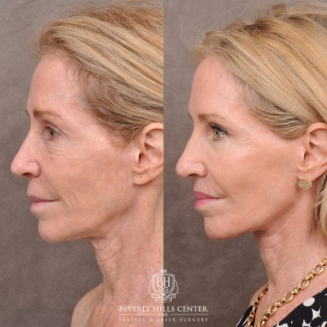 Beverly Hills Center Female Patient Before and After Comprehensive Revision Auralyft