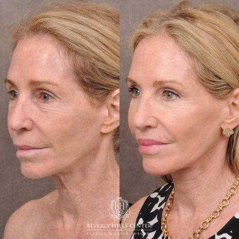 Beverly Hills Center Female Patient Before and After Comprehensive Revision Auralyft