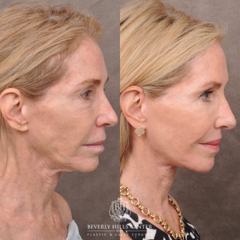 Beverly Hills Center Female Patient Before and After Comprehensive Revision Auralyft