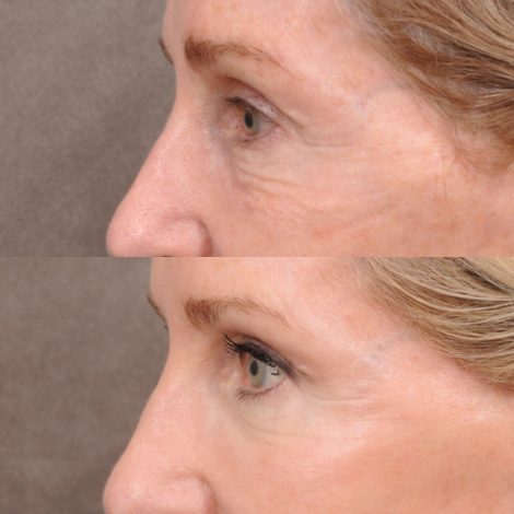 Beverly Hills Center Female Patient Before and After Comprehensive Revision Auralyft