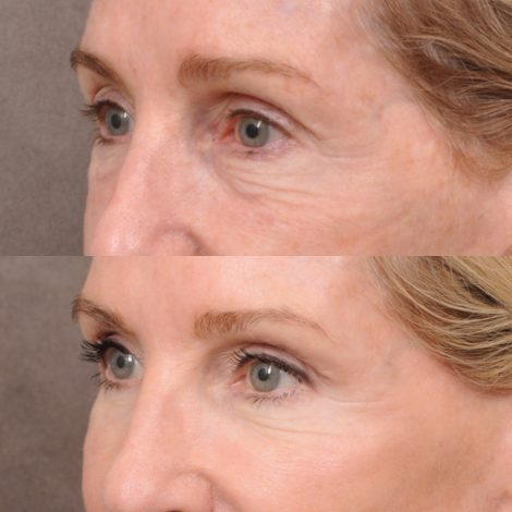 Beverly Hills Center Female Patient Before and After Comprehensive Revision Auralyft