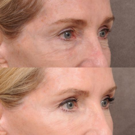 Beverly Hills Center Female Patient Before and After Comprehensive Revision Auralyft