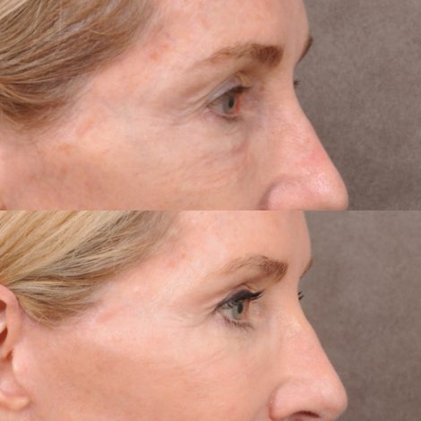 Beverly Hills Center Female Patient Before and After Comprehensive Revision Auralyft
