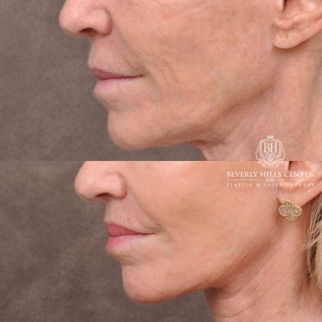 Beverly Hills Center Female Patient Before and After Comprehensive Revision Auralyft