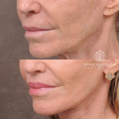 Beverly Hills Center Female Patient Before and After Comprehensive Revision Auralyft