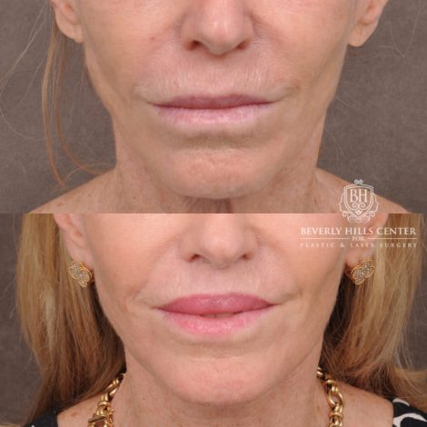 Beverly Hills Center Female Patient Before and After Comprehensive Revision Auralyft