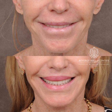 Beverly Hills Center Female Patient Before and After Comprehensive Revision Auralyft