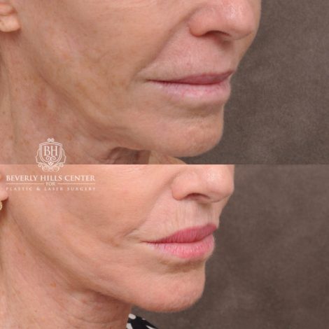 Beverly Hills Center Female Patient Before and After Comprehensive Revision Auralyft