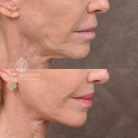 Beverly Hills Center Female Patient Before and After Comprehensive Revision Auralyft