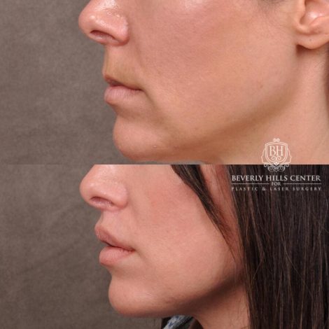 Beverly Hills Center Female Patient Before and After Lip Lift