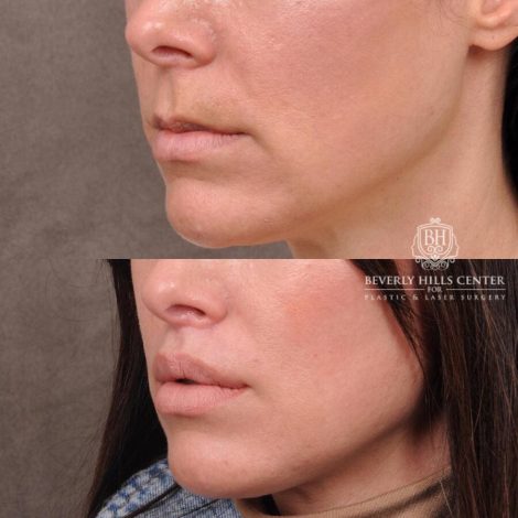 Beverly Hills Center Female Patient Before and After Lip Lift