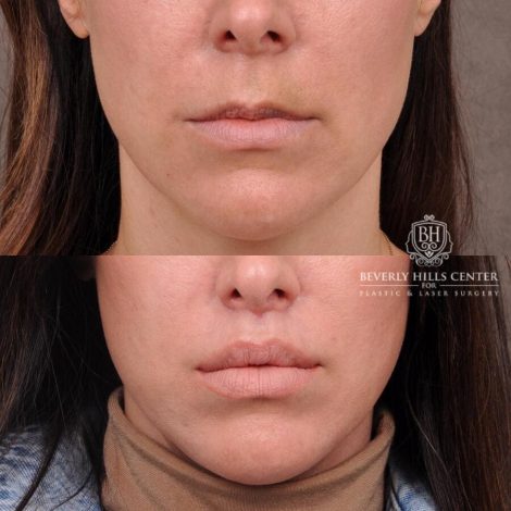 Beverly Hills Center Female Patient Before and After Lip Lift