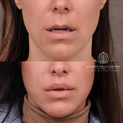 Beverly Hills Center Female Patient Before and After Lip Lift