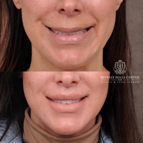Beverly Hills Center Female Patient Before and After Lip Lift
