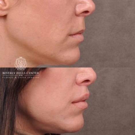 Beverly Hills Center Female Patient Before and After Lip Lift