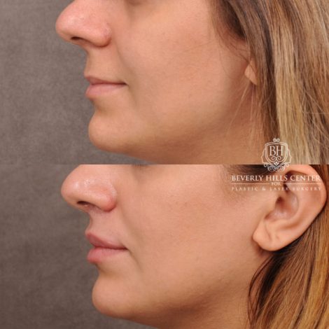 Beverly Hills Center Female Patient Before and After Deep Plane Upper Lip Lift