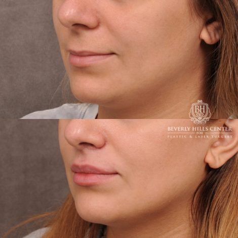 Beverly Hills Center Female Patient Before and After Deep Plane Upper Lip Lift