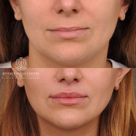Beverly Hills Center Female Patient Before and After Deep Plane Upper Lip Lift