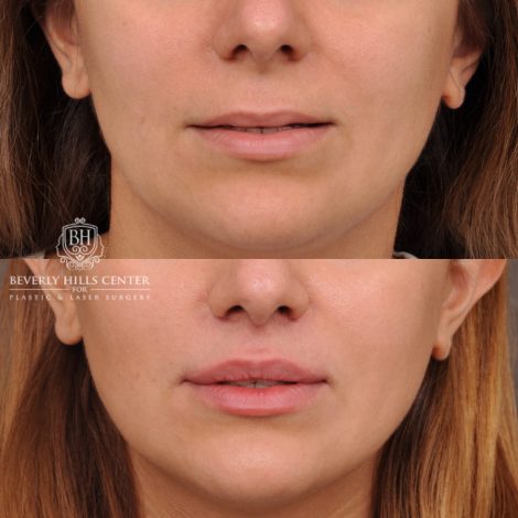 Beverly Hills Center Female Patient Before and After Deep Plane Upper Lip Lift