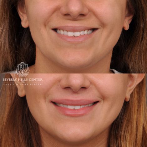 Beverly Hills Center Female Patient Before and After Deep Plane Upper Lip Lift
