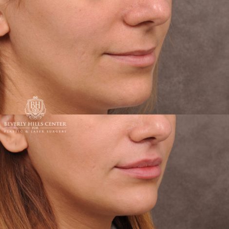 Beverly Hills Center Female Patient Before and After Deep Plane Upper Lip Lift