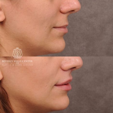 Beverly Hills Center Female Patient Before and After Deep Plane Upper Lip Lift