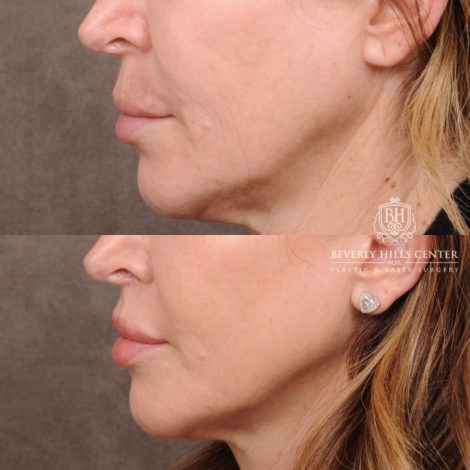 Beverly Hills Center Female Patient Before and After Deep Plane Upper Lip Lift