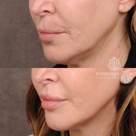 Beverly Hills Center Female Patient Before and After Deep Plane Upper Lip Lift