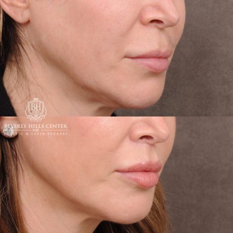 Beverly Hills Center Female Patient Before and After Deep Plane Upper Lip Lift
