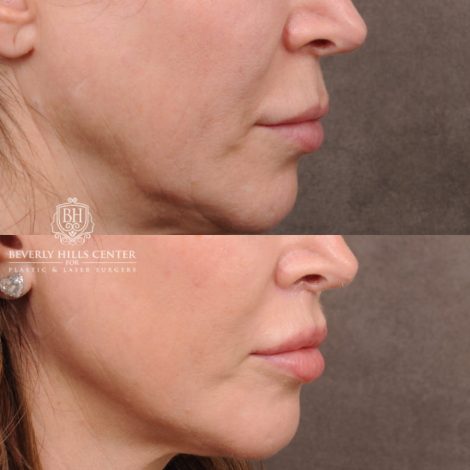 Beverly Hills Center Female Patient Before and After Deep Plane Upper Lip Lift