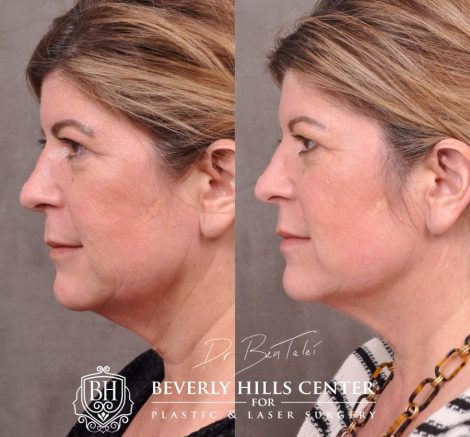 Beverly Hills Center Female Patient Before and After Profound Rf Skin and Neck Thightening