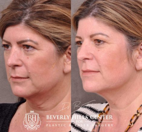 Beverly Hills Center Female Patient Before and After Profound Rf Skin and Neck Thightening