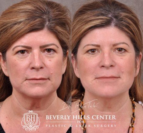 Beverly Hills Center Female Patient Before and After Profound Rf Skin and Neck Thightening