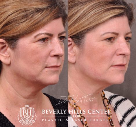 Beverly Hills Center Female Patient Before and After Profound Rf Skin and Neck Thightening