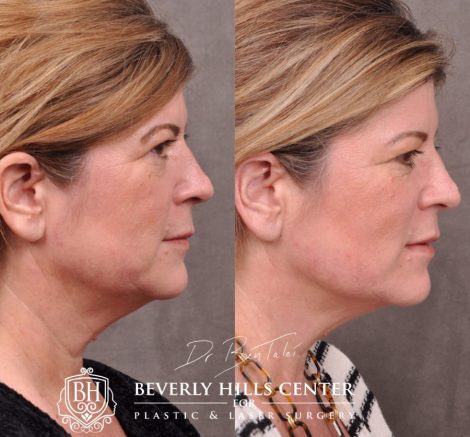 Beverly Hills Center Female Patient Before and After Profound Rf Skin and Neck Thightening