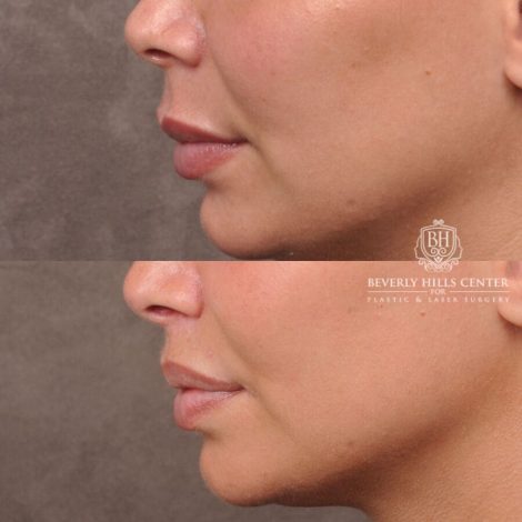 Beverly Hills Center Female Patient Before and After Deep Plane Modified Lip Lift