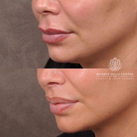 Beverly Hills Center Female Patient Before and After Deep Plane Modified Lip Lift
