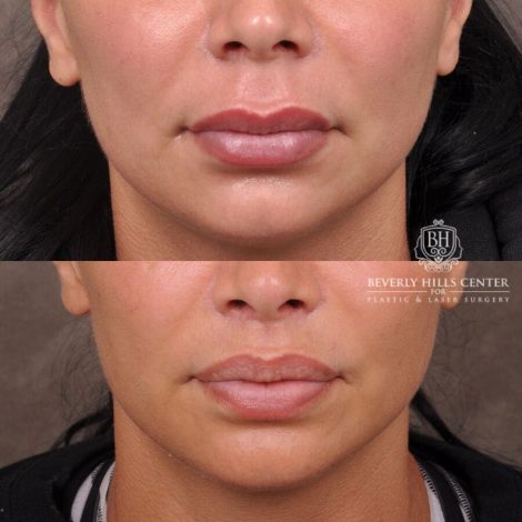 Beverly Hills Center Female Patient Before and After Deep Plane Modified Lip Lift