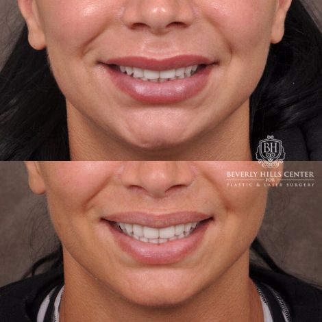Beverly Hills Center Female Patient Before and After Deep Plane Modified Lip Lift