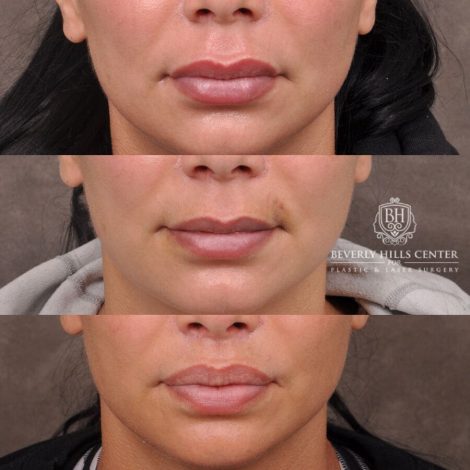 Beverly Hills Center Female Patient Before and After Deep Plane Modified Lip Lift