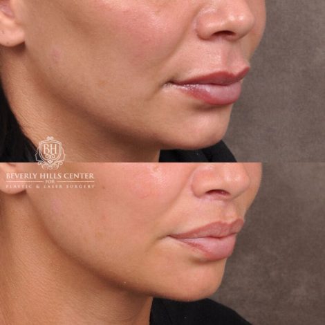 Beverly Hills Center Female Patient Before and After Deep Plane Modified Lip Lift