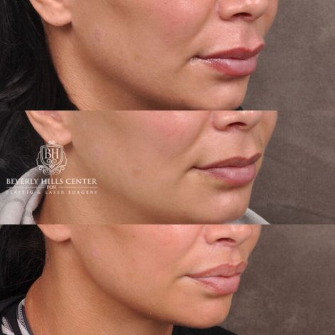 Beverly Hills Center Female Patient Before and After Deep Plane Modified Lip Lift