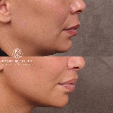 Beverly Hills Center Female Patient Before and After Deep Plane Modified Lip Lift